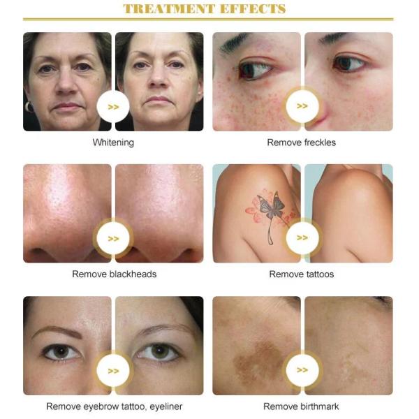 3 In 1 Q Switched ND Yag laser tattoo machine 2 - 8mm Spot Size