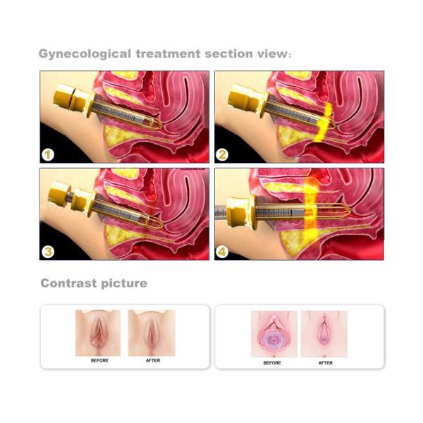 Clinic vaginal Laser Machines fractional CO2 ance scar removal laser Without Side - Effects