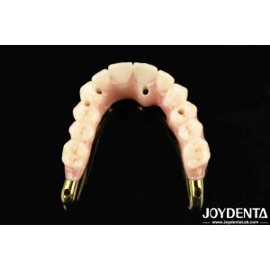 Restoring Chewing Function Ti-Bar Zirconia Hybrid Bridge With High Biocompatibil