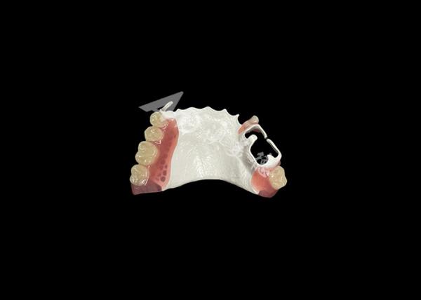 High Quality Comfortable Partial Denture With HPP Framework Restores Chewing And