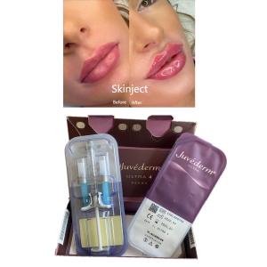 China Lips Reshape Juvederm Hyaluronic Acid Dermal Filler With Lido Ultra4 2X1ml on sale