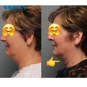 30W 1-10Hz Repetition Rate Endolift Laser Machine For Non Invasive Skin