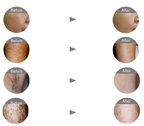 Micro Channel 808nm Diode Laser Hair Removal Machine Stationary Style