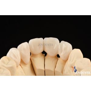 Highly Customizable Layered Zirconia Dental Crowns And Bridges Long Lasting