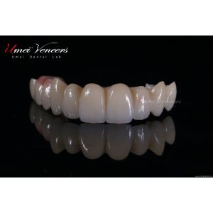 China Natural Bright White Veneers on sale