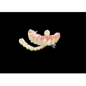 Implant supported dentures Bridge The Ultimate Dental Solution For Missing Teeth