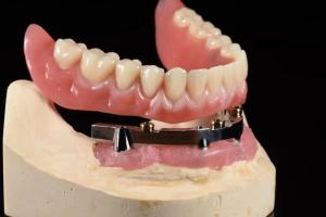 Cheap Titanium Implant Supported Dentures Precise Ivoclar Denture Over Implants for sale
