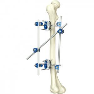 China Excellent Quality Instrument Orthopedic Tibia & Percone External Fixator Orthopedic Surgical Instruments on sale