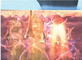 FDA technology most advanced painfree efficient ipl laser hair removal machine for sale