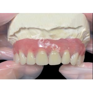 Titanium implant supported Bar Attachment Dentures from china dental lab