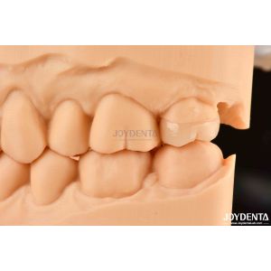 High Strength Emax Inlay Onlay A2 Color Long Lasting For Damaged Teeth