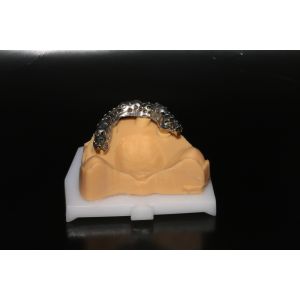 Class 5 All On 4 AOX Implants With Hybrid Titanium Bar / Clips / Metal Mesh /