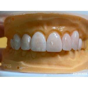 Cheap High Permeability Natural Looking Veneers Porcelain Veneers Emax Customized for sale