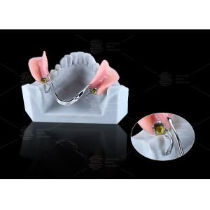 Titanium Dental Implant Ball Attachments Comfortable Secure Denture Retention