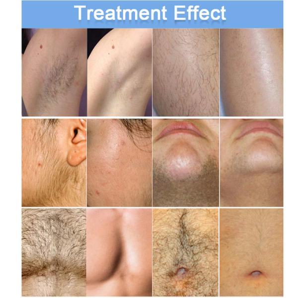 Professional 3-Wave Laser Hair Removal Device With Dual Cooling & Permanent Results For High-Traffic Salons & Clinics