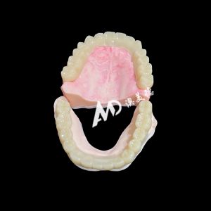Lightweight PMMA Temporary Bridges with Hollow Design for Implant Restorations