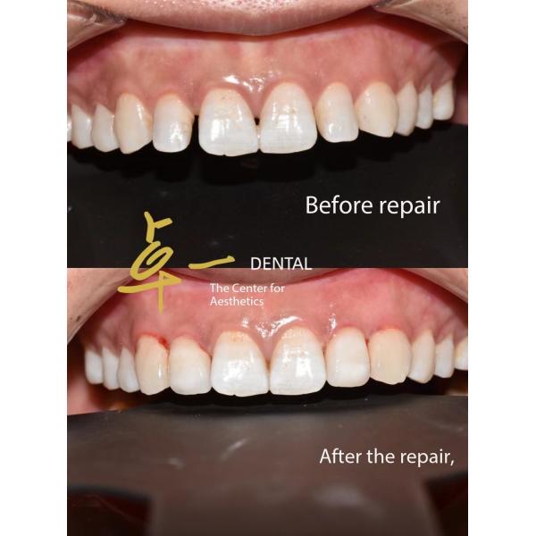 Say Hello To A Flawless Smile With Cosmetic Dental Veneers No Discoloration No