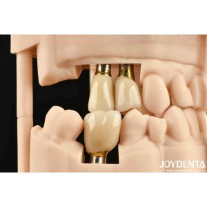 High Durability White Finish Implant Crown And Bridge With Accurate Fit