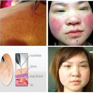 Most effective spider vein spot removal machine