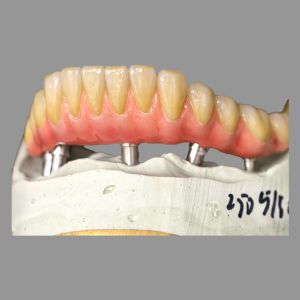 Class I AOX Implants All On 4 Hybrid Titanium Screw Retained Full Zirconia
