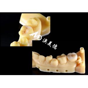 Precision Ceramic Inlays and Onlays for Teeth Repair with Natural Color