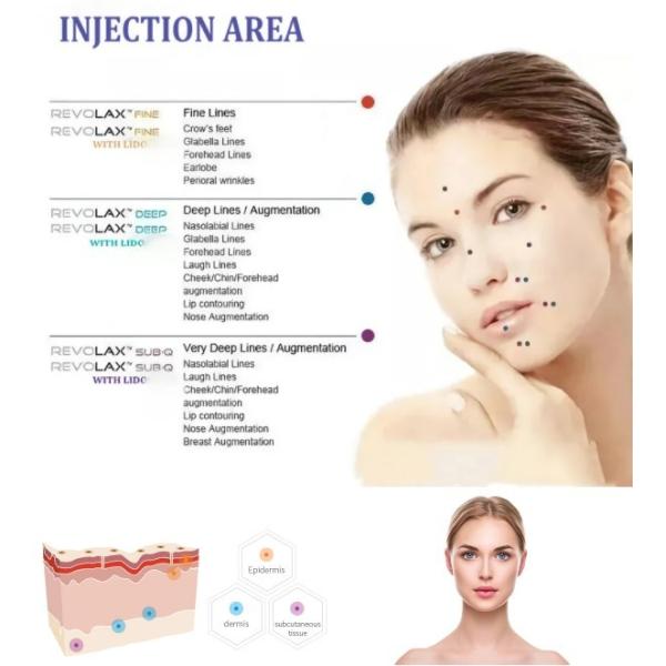 Injectable Revolax 1.1Ml HA Gel Dermal Filler Face Filling With Fine Deep And Sub -Q