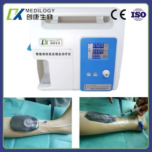 Wound Npwt Dressing Kit Negative Pressure Disposable NPWT Devices Intelligent