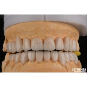 High Translucency Layered Zirconia For Full Contour Dental Restorations