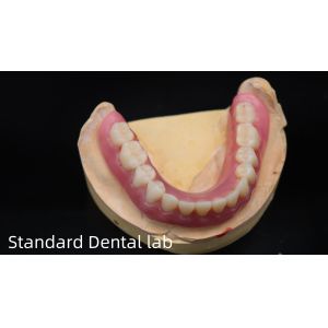 Titanium Implant Supported Dentures Precise Ivoclar Denture Over Implants