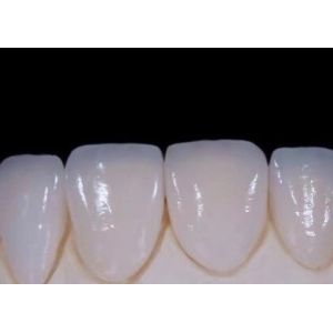 Cheap EMAX Durablity CAD/CAM Dental Composite Veneers Highly Detailed Accurate for sale