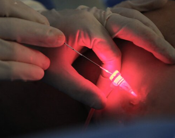 Portable 980nm Medical Diode Laser Treatment Machine For Greater Saphenous Vein