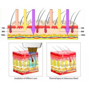 1064nm Diode Laser Hair Remove Device Ice Titanium 3 Wavelength