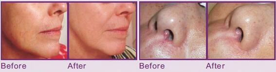 Big promotion!!!Rbs vascular spider veins removal/varicose veins removal/spider veins vascular