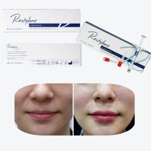 Juvederm Cross Linked Injectable Dermal Filler For Lips