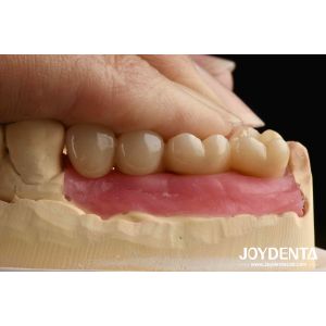 China Ultra-precision processing Zirconia Implants All-Zirconium Integrated Crown on sale