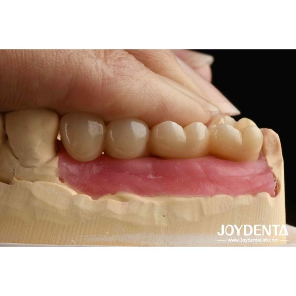 Quality Ultra-precision processing Zirconia Implants All-Zirconium Integrated Crown wholesale