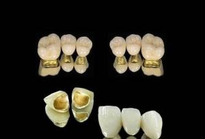 China High Nobel Yellow Gold Crown Be Nickel Free PFM Tooth Crown on sale
