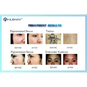 Multifunction Q Switched Nd Yag Laser Tattoo Removal Pigmentation Removal