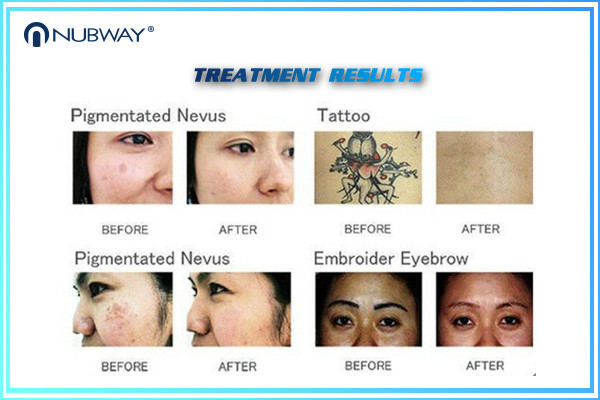 Multifunction Q Switched Nd Yag Laser Tattoo Removal Pigmentation Removal