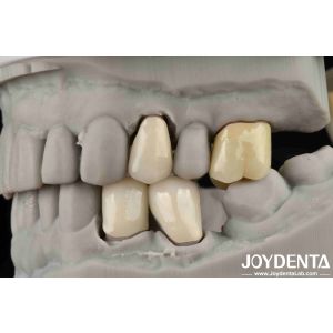 Easy Cementation Emax Inlay Onlay Medium Strength Natural-looking Esthetics