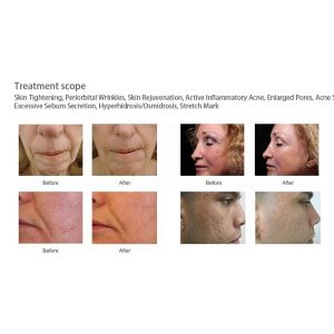 All skin problem solution! scarlet rf needle machine fractional rf microneedle