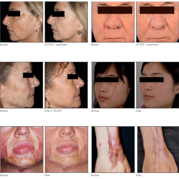 Scars Removal CO2 Fractional Laser Machine