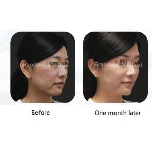 OEM Customization PCL Filler Medical Beauty Injection Collagen Stimulator