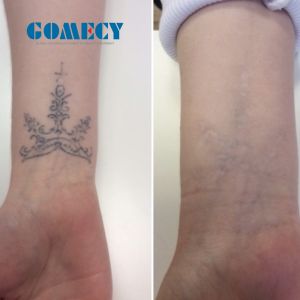 Q Switched ND Yag Laser Machine 2000W High Energy And 6 Functions 100-2000J For