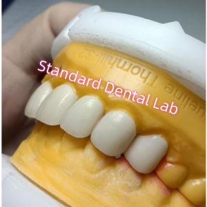 Ivoclar Zirconia Crown Veneers High Translucency Esthetic