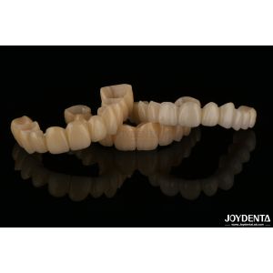 Natural Looking Porcelain Layered Zirconia Bridges Wear Resistance High