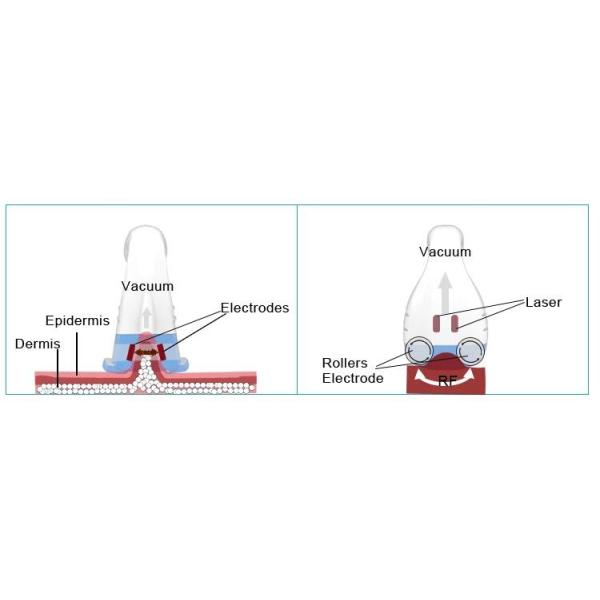 Roller Massage Vacuum Slimming Machine 25m3/H Output 100kPa Max Pressure