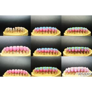 High Biocompatibility Feldspathic Ceramic Veneer Glossy For Dental Restorations