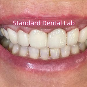 Ivoclar Zirconia Crown Veneers High Translucency Esthetic
