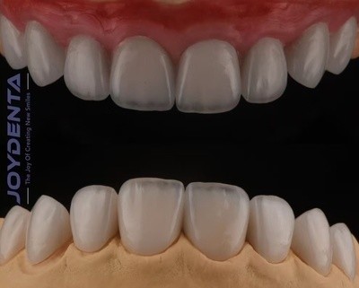 High Translucency Feldspathic Veneer , Cosmetic Porcelain Veneers With Strong